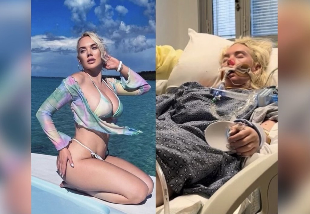 La modelo que debió ser amputada de una pierna tras infectarse con una bacteria come&nbsp;carne