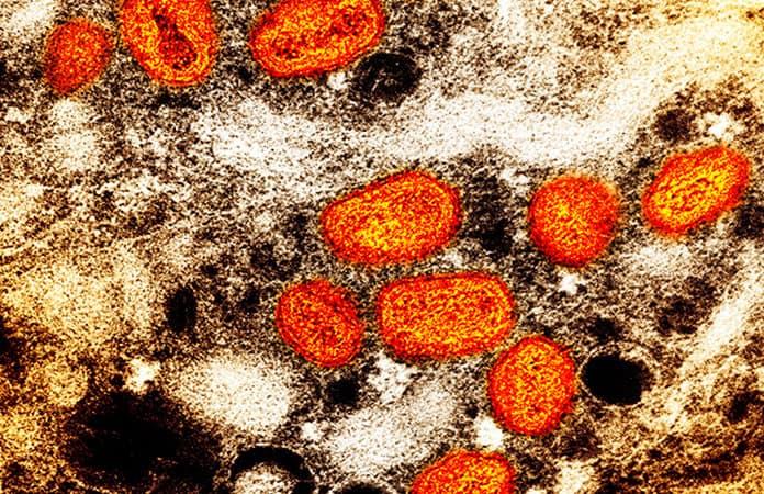 En Colombia se han registrado 4.257 contagios con virus del mono desde mayo de 2022, de acuerdo con el&nbsp;INS